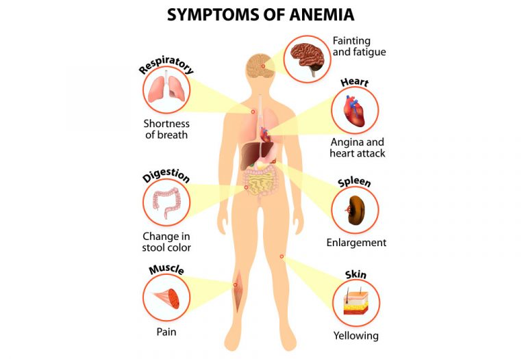 Iron-Deficiency Anemia During Pregnancy: Causes, Treatment & more