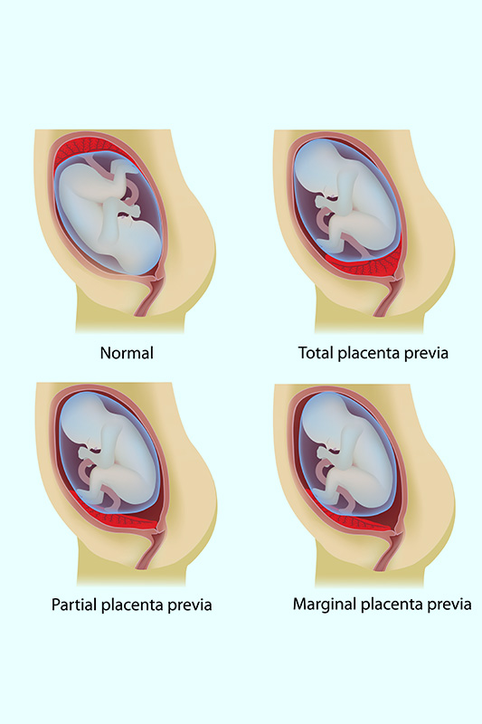 Low lying Placenta Signs, Causes & Treatment