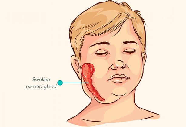 Mumps in Kids – Reasons, Signs & Treatment