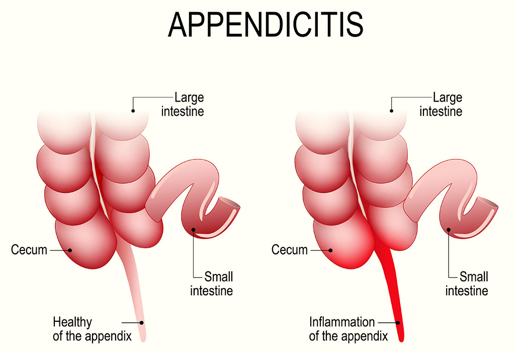 childhood-appendicitis-reasons-signs-remedies