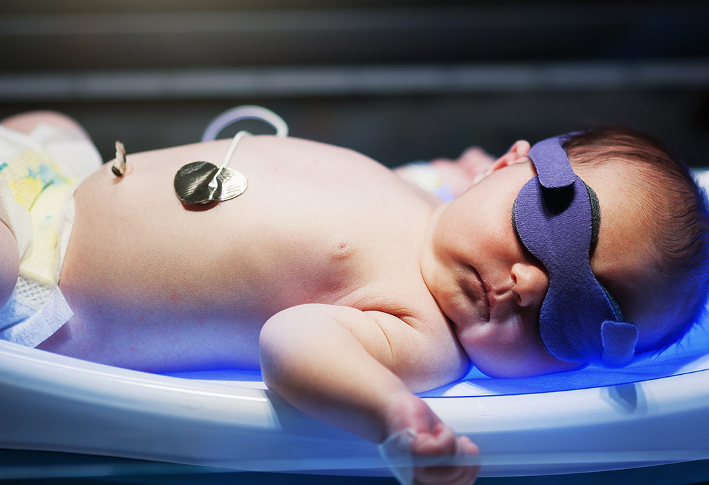 Jaundice in Newborn Babies Reasons, Signs & Treatment