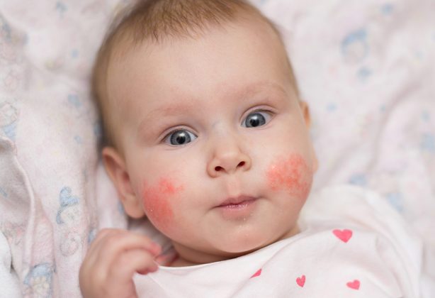 Slapped Cheek Syndrome: Reasons, Signs & Treatment