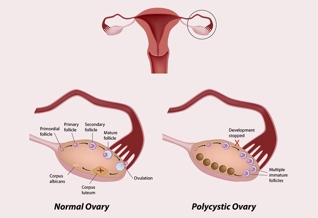 Con ovarios poliquisticos se puede tener hijos