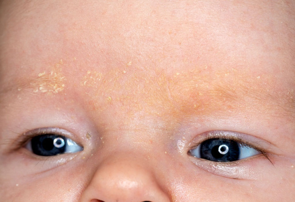 Common Skin Allergies In Babies | FirstCry Parenting