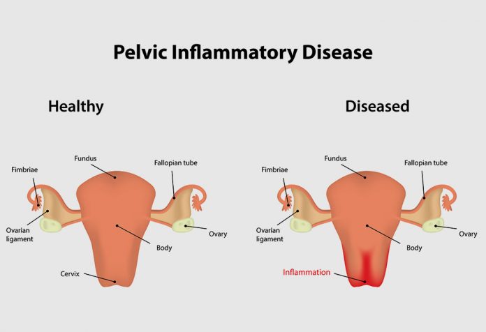 PELVIC INFLAMMATORY DISEASE