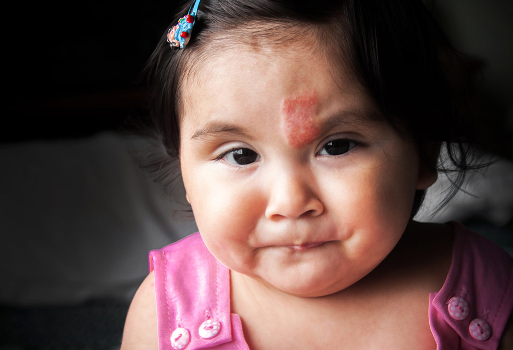 Birthmarks In Babies Types Causes And Treatment