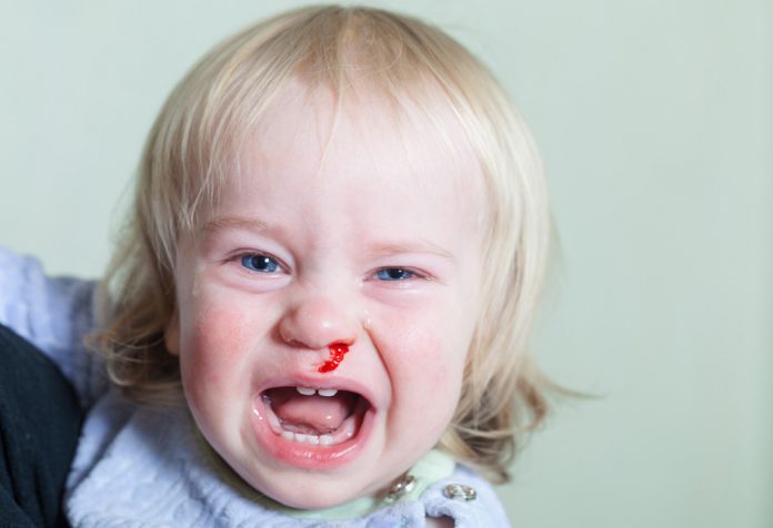 A baby with a bleeding nose