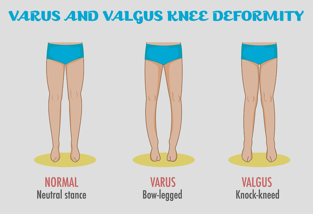 Bowed Legs In Infants - Reasons, Signs, Diagnosis & Treatment