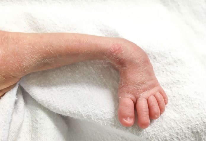 Clubfoot in a newborn