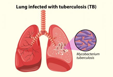 Tuberculosis (TB) During Pregnancy- Causes, Symptoms & Treatment