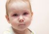 A baby with redness in the eyes crying due to discomfort