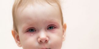 A baby with redness in the eyes crying due to discomfort