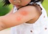 Dengue in Children - Signs, Diagnosis & Treatment