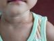 A child with a neck rash