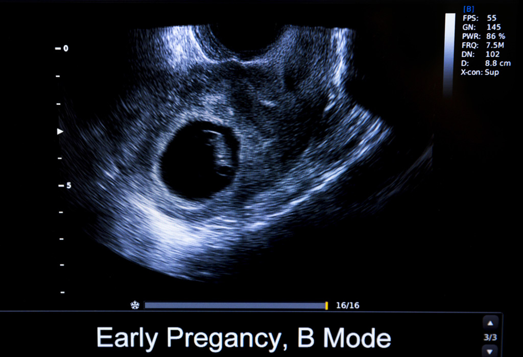 What Is Gestational Sac During Pregnancy