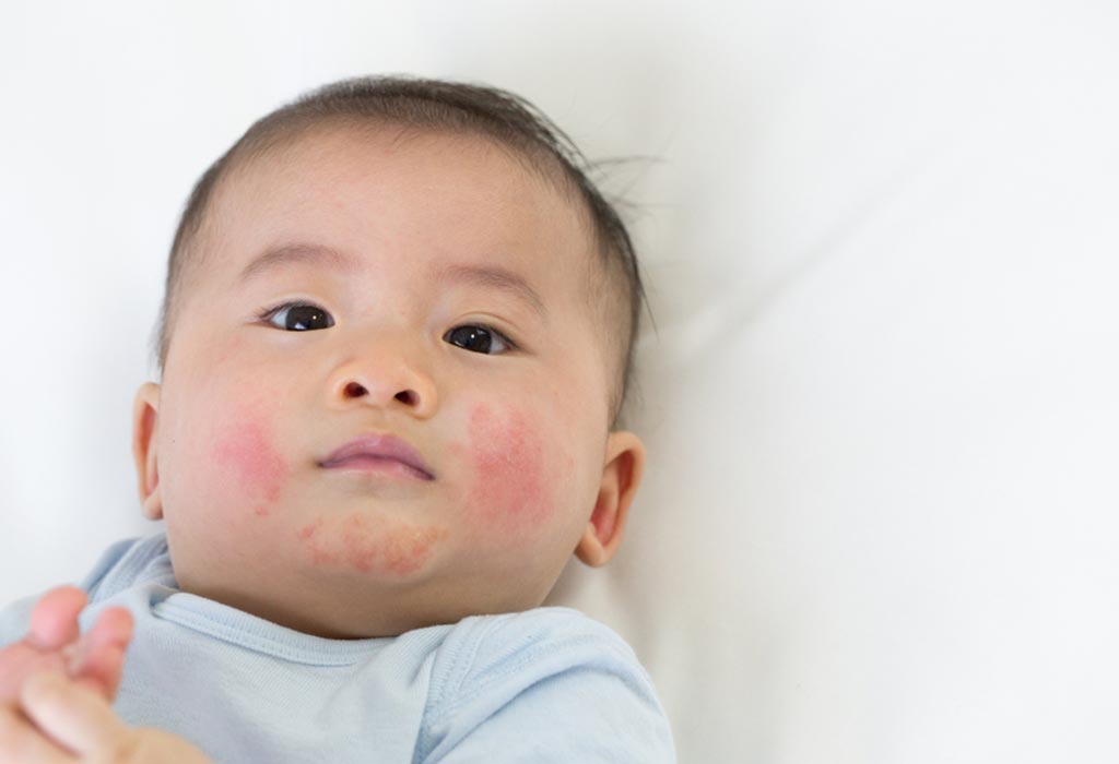Baby Teething Rash Causes, Home Remedies & Prevention