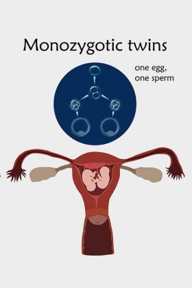 Monozygotic (Identical) Twins: Facts and Misconceptions