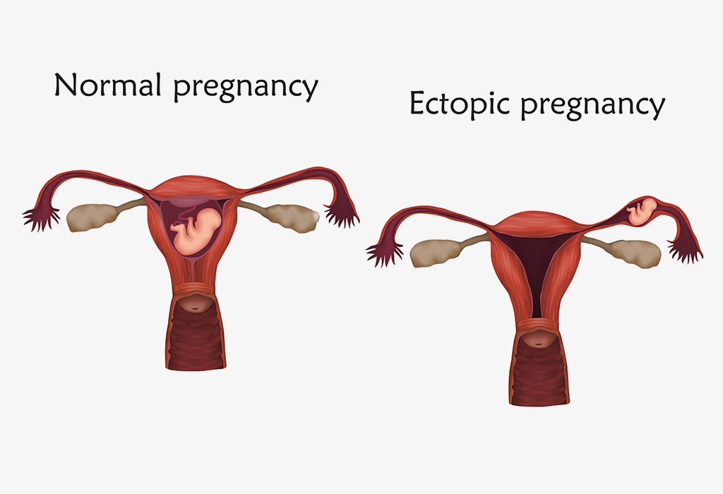 heterotopic-pregnancy-causes-symptoms-and-treatment