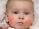 Baby rash on face