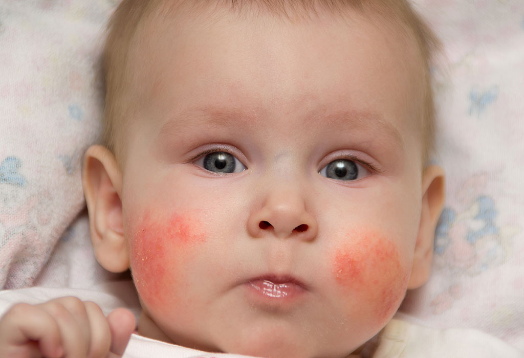 Baby Rash on Face Types, Reasons and Home Remedies