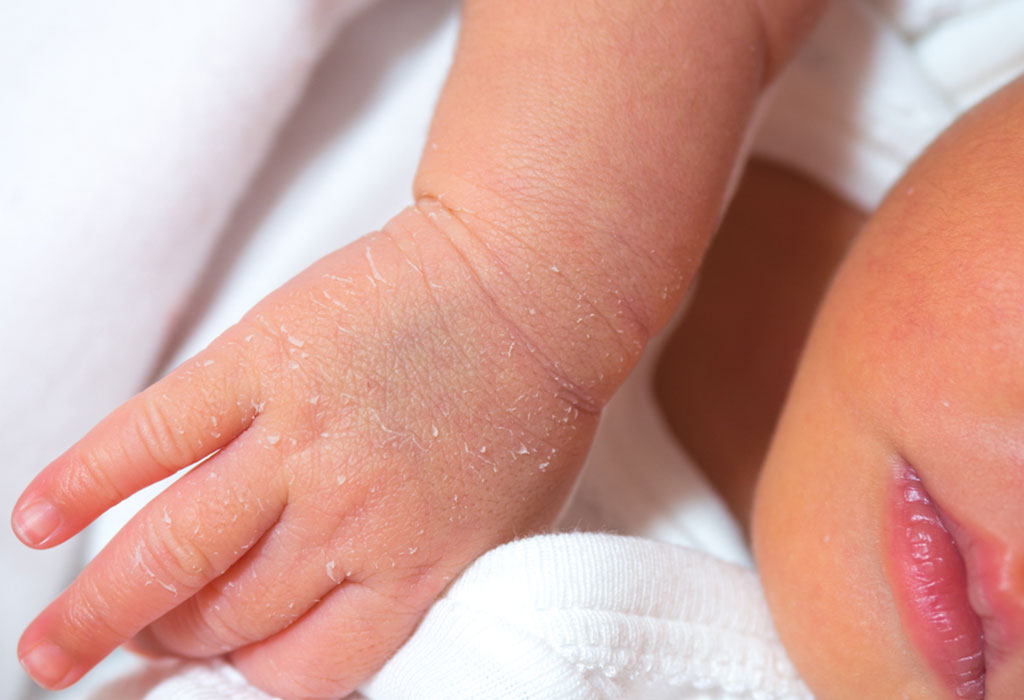 kredsløb dæk Udsæt Newborn Skin Peeling: Causes, Treatment and Prevention