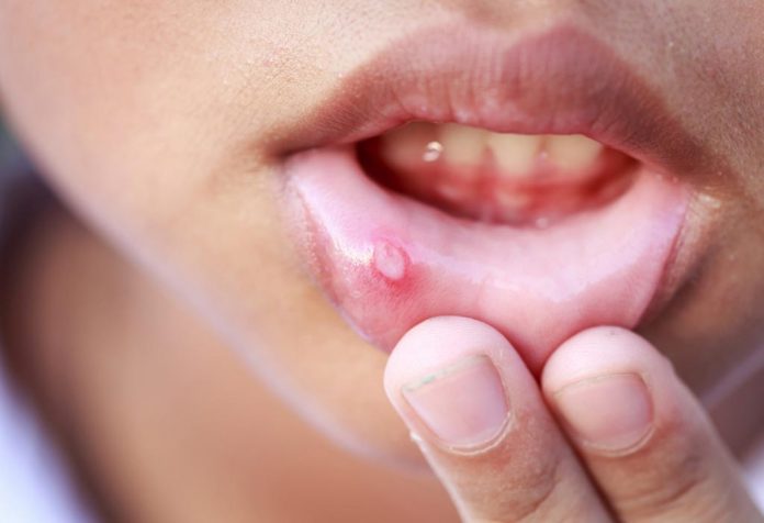 10 Home Remedies for Mouth Ulcer in Babies and Children