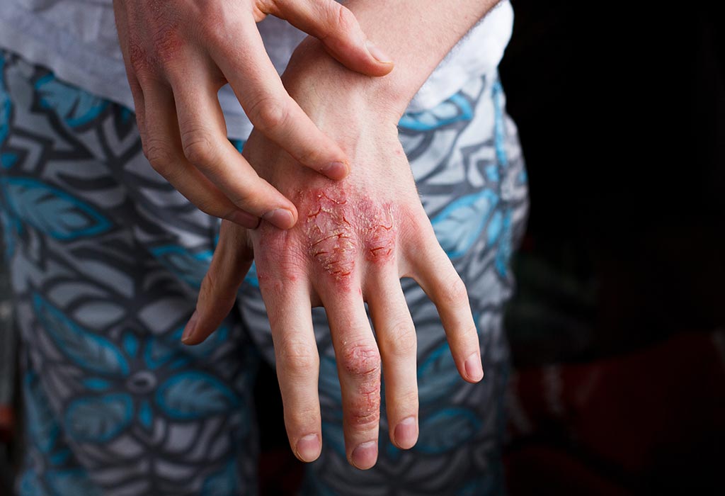 Psoriasis during Pregnancy Symptoms, Complications & Treatment