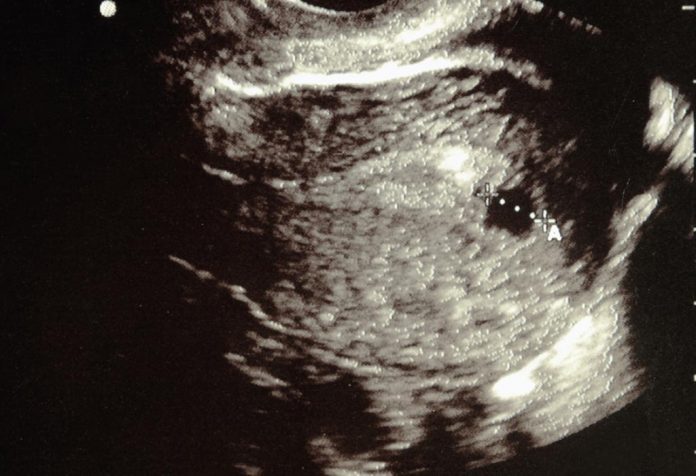 6 Weeks Pregnant Ultrasound