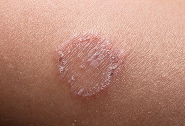 Ringworm in Children - Reasons, Symptoms & Treatment