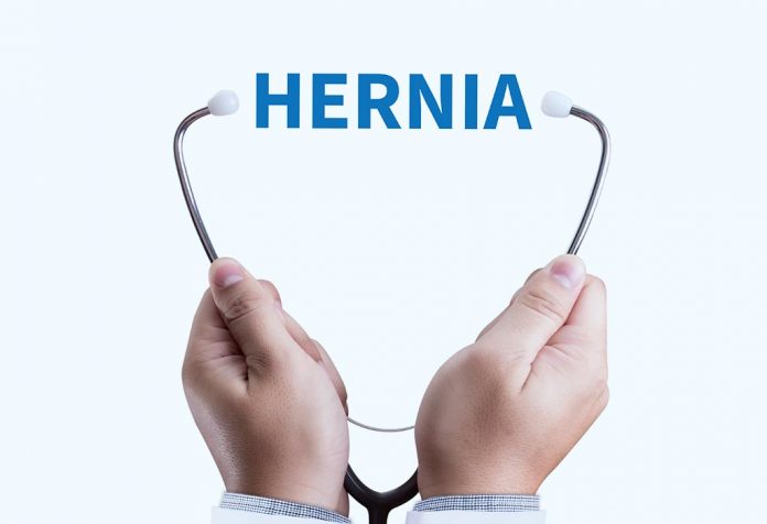 An Umbilical hernia