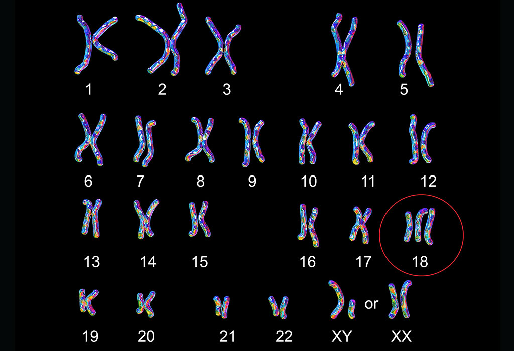 chromosonal-abnormalities-in-babies-causes-signs-diagnosis