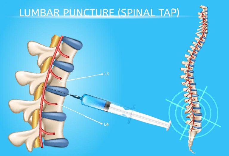 Lumbar Puncture in Children Procedure, Benefits and Risks