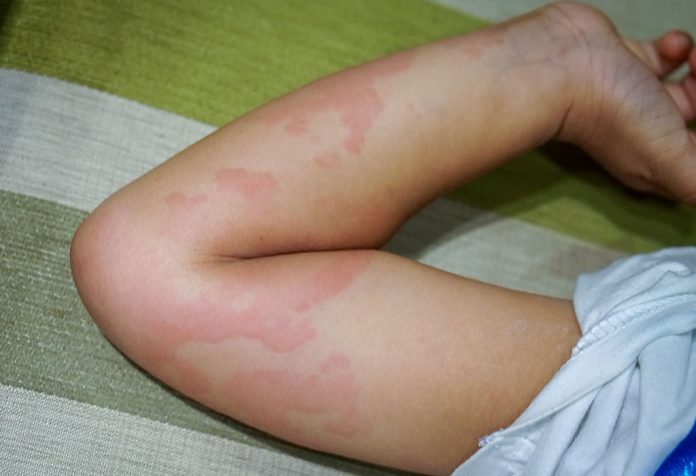 Papular Urticaria in Children - Causes, Symptoms and Treatment