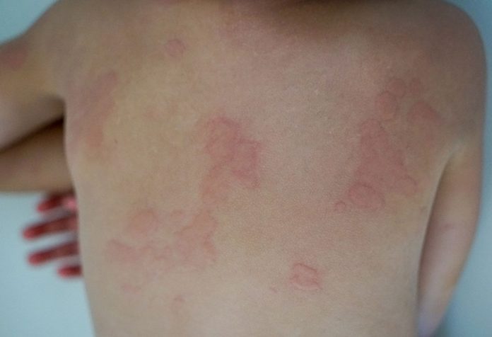 how-deal-with-papular-urticaria-in-kids