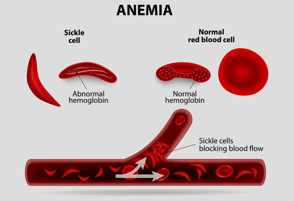 sickle-cell-disease-in-pregnancy-types-symptoms-treatment