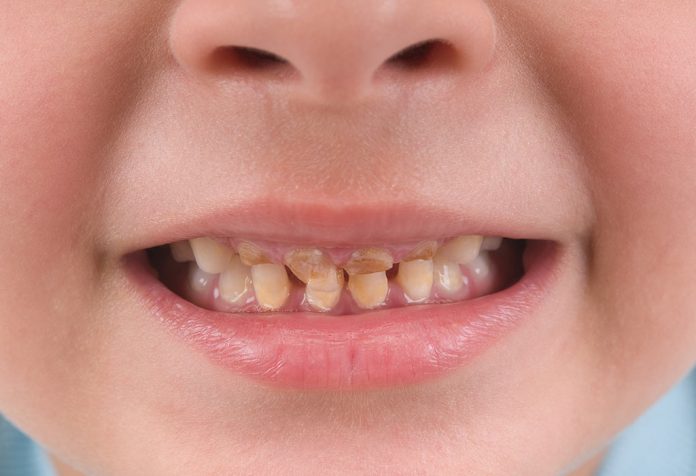Yellow and Other Discoloration of Teeth in Children